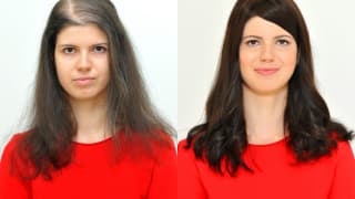 Foto – Lösung für dünnes Haar und Glatze – Lucia