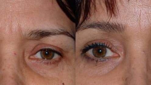 Lifting der Augenbrauen