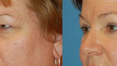 Lifting der Augenbrauen