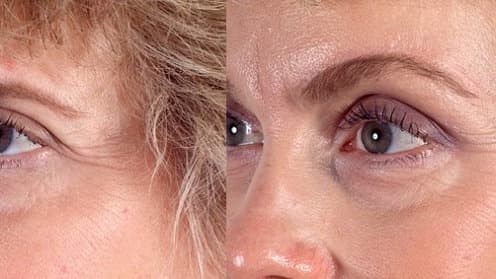 Lifting der Augenbrauen