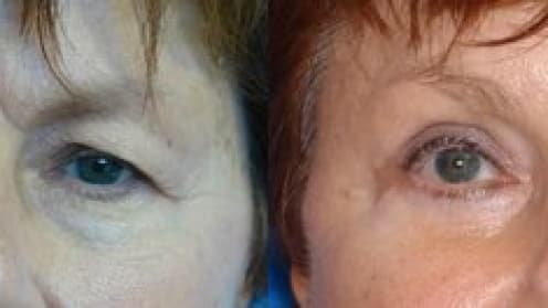 Lifting der Augenbrauen