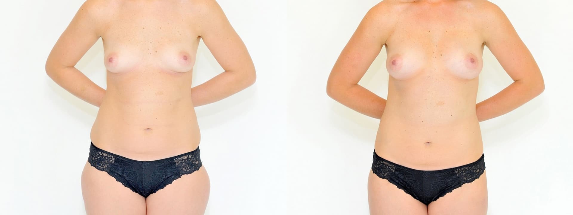 Lipotransfer - přenos tuku