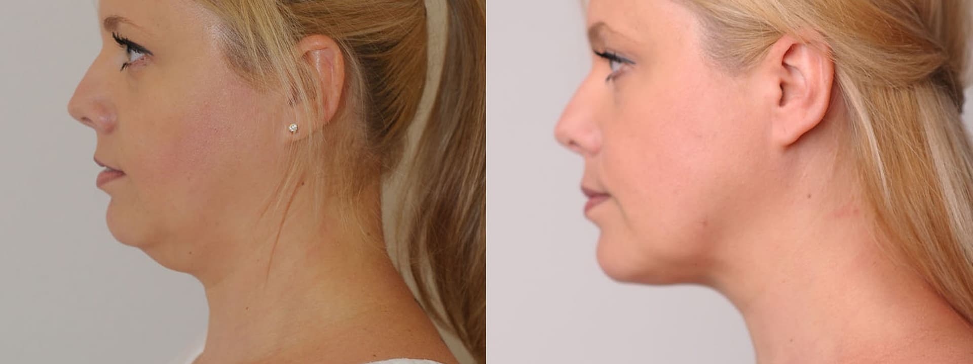 Neinvazivní zpevnění povolené kůže podbradku laserem