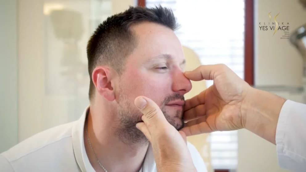 Plastika nosu - Jakub