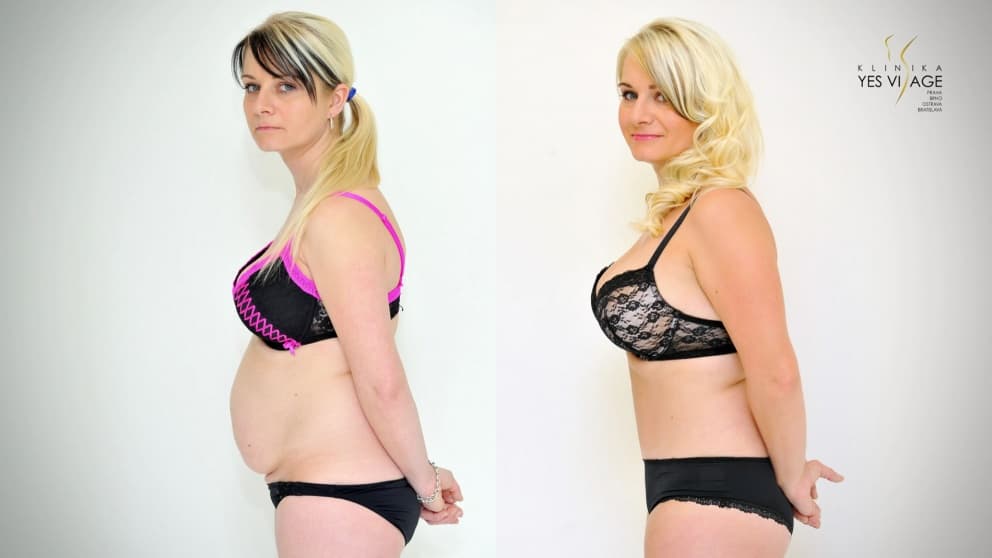 PROMĚNA: Abdominoplastika - Plastika břicha