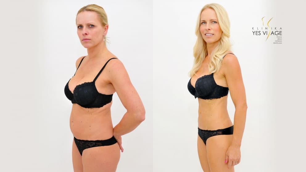 Laserová liposukce SLIMLIPO