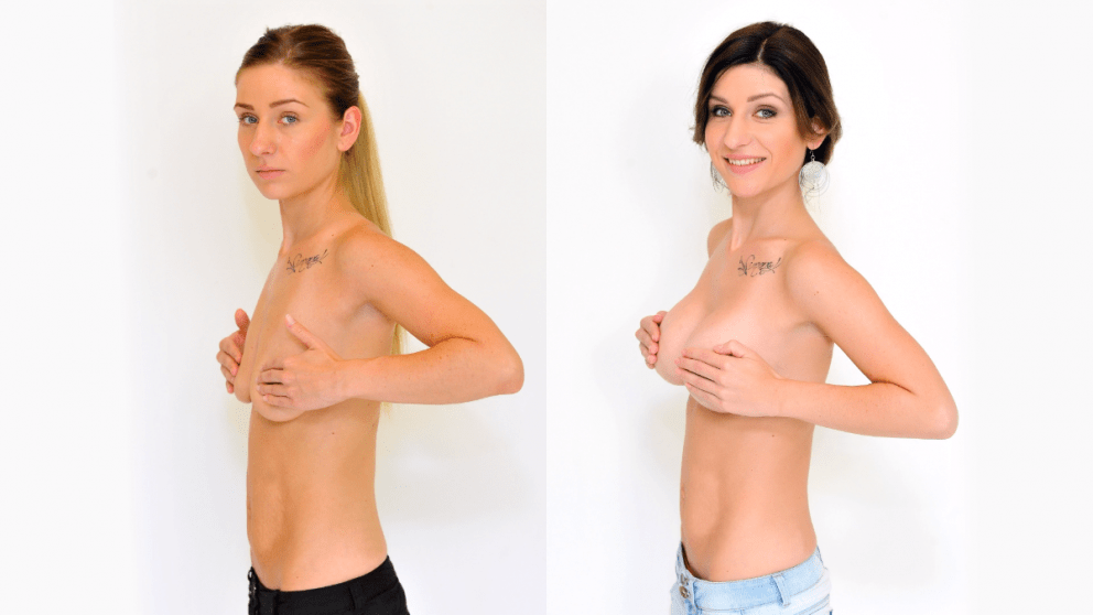 Brustvergrößerung und –modellierung an der YES VISAGE-Klinik