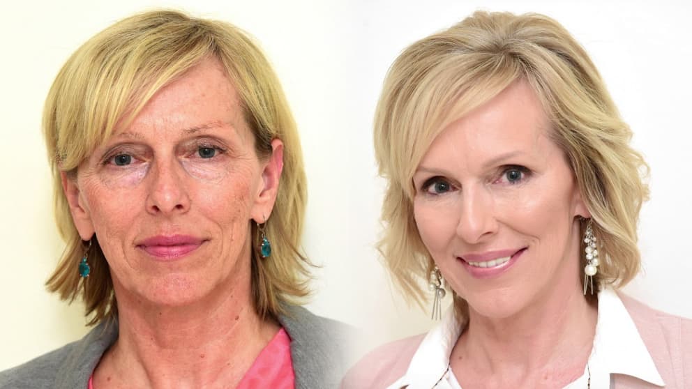 Výplně, botox a laser 4D