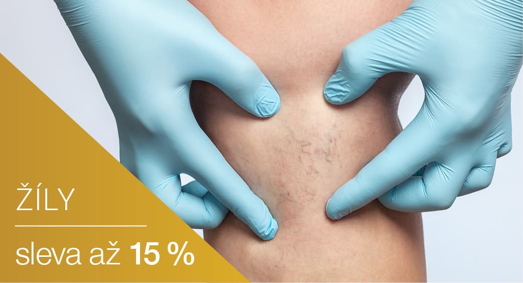 LETNÍ SLEVY až 15 %! Exkluzivně na žíly. Sleva platí jen pro zákrok, který proběhne v termínu 1.7.2022 – 31.10.2022